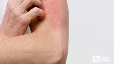 Alerji hastalıkları toplumun yüzde 20'sini etkiliyor