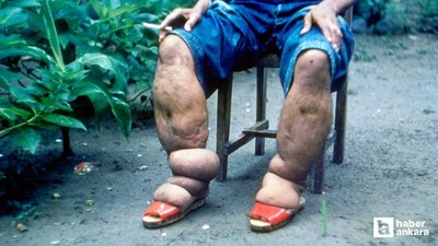 Fil hastalığı nedir, tedavisi var mı?