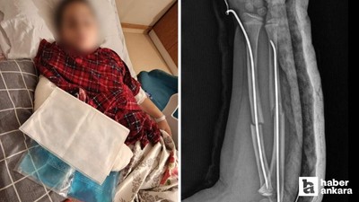 Büyükçekmece'de ilkokulda akran zorbalığı: Arkadaşının kolunu 2 yerden kırdı