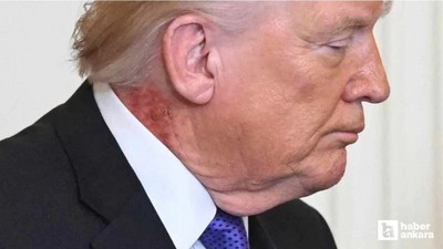 Trump'ın boynundaki kızarıklığın nedenini doktoru açıkladı