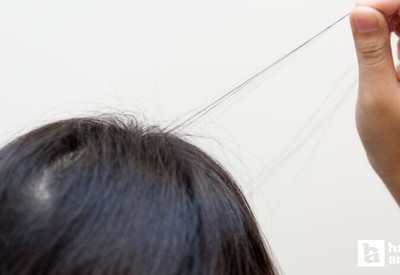 Gıda zehirlenmesi sandılar, midesinden kilolarca saç çıktı