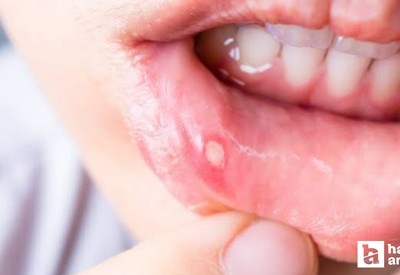 Ağızda geçmeyen yaralara dikkat! Kanserin habercisi olabilir