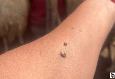 Keneler en çok vücutta buralara yapışıyor!