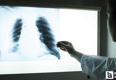 50 yaş üstü sigara tiryakilerine uyarı: Mutlaka yaptırın!