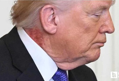 Trump'ın boynundaki kızarıklığın nedenini doktoru açıkladı