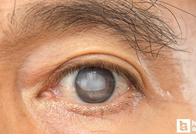 Geçen yıl 750 bin kişiye göz tansiyonu tanısı konuldu