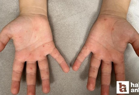 Çocuklu ailelere uyarı: El, ayak ve ağız hastalığına dikkat!