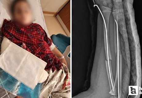 Büyükçekmece'de ilkokulda akran zorbalığı: Arkadaşının kolunu 2 yerden kırdı