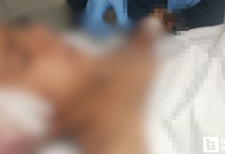 Altındağ'da köpeklerin saldırısına uğrayan çocuğun tedavisi devam ediyor