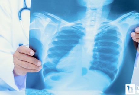 Türkiye'deki tüberküloz vaka sayısında gerileme kaydedildi