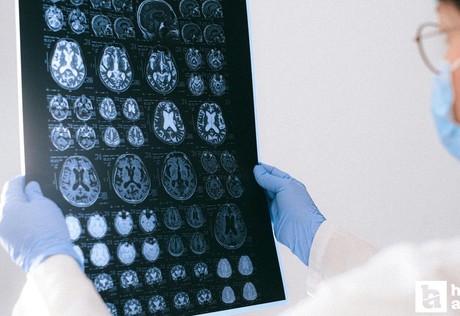 D vitamin seviyesi ve Alzheimer arasında ilişki olabilir