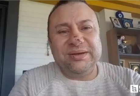 Pitbull saldırısına uğrayan Onur Akay, 1,5 gün yoğun bakımda tedavi edildi