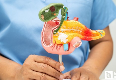 Uzmanlar obezite ve pankreas kanseri arasındaki ilişkiye dikkat çekti