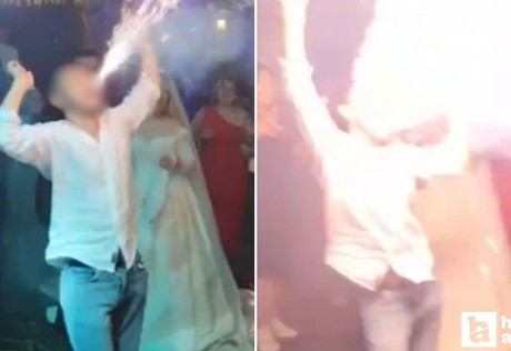 Pursaklar'da düğünde ağzında meşale patlayan genç yüzünden yaralandı