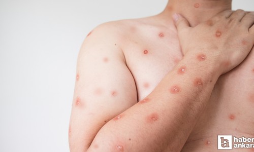 DSÖ Maymun Çiçeği hastalığı için küresel acil durum ilan etti