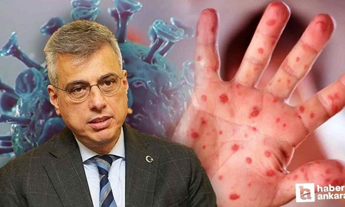 Sağlık Bakanı Memişoğlu'ndan yeni maymun çiçeği virüsü açıklaması!