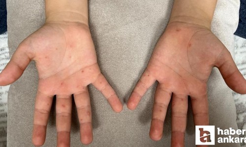 El ayak ağız hastalığı salgına dönüştü: Belirtileri neler?