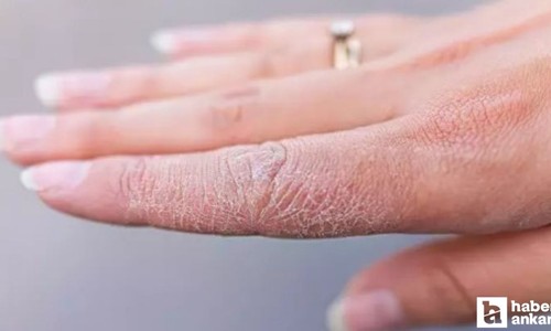 Cilt kuruluğunu hafife almayın: Bakın neyin belirtisiymiş!