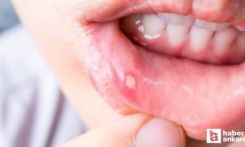 Ağızda geçmeyen yaralara dikkat! Kanserin habercisi olabilir
