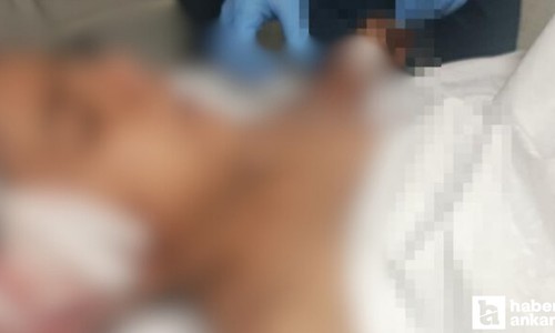 Altındağ'da köpeklerin saldırısına uğrayan çocuğun tedavisi devam ediyor