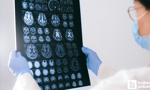 D vitamin seviyesi ve Alzheimer arasında ilişki olabilir