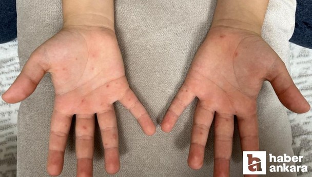Çocuklu ailelere uyarı: El, ayak ve ağız hastalığına dikkat!