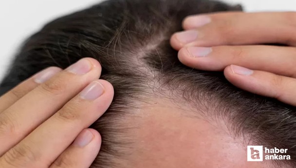 Erkekler dikkat: Bu içecekler saç dökülmesine neden oluyor