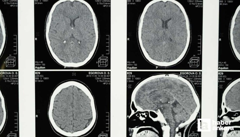 Alzheimer belirtisi olduğu ortaya çıktı! Uyurken bunu yaşıyorsanız dikkat