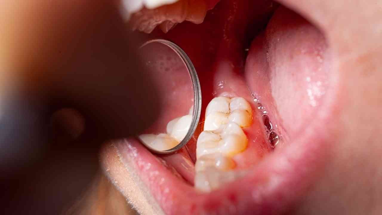 Dolgulu dişlerin çürümemesi için bu 2 kritere dikkat edin! - Resim: 2