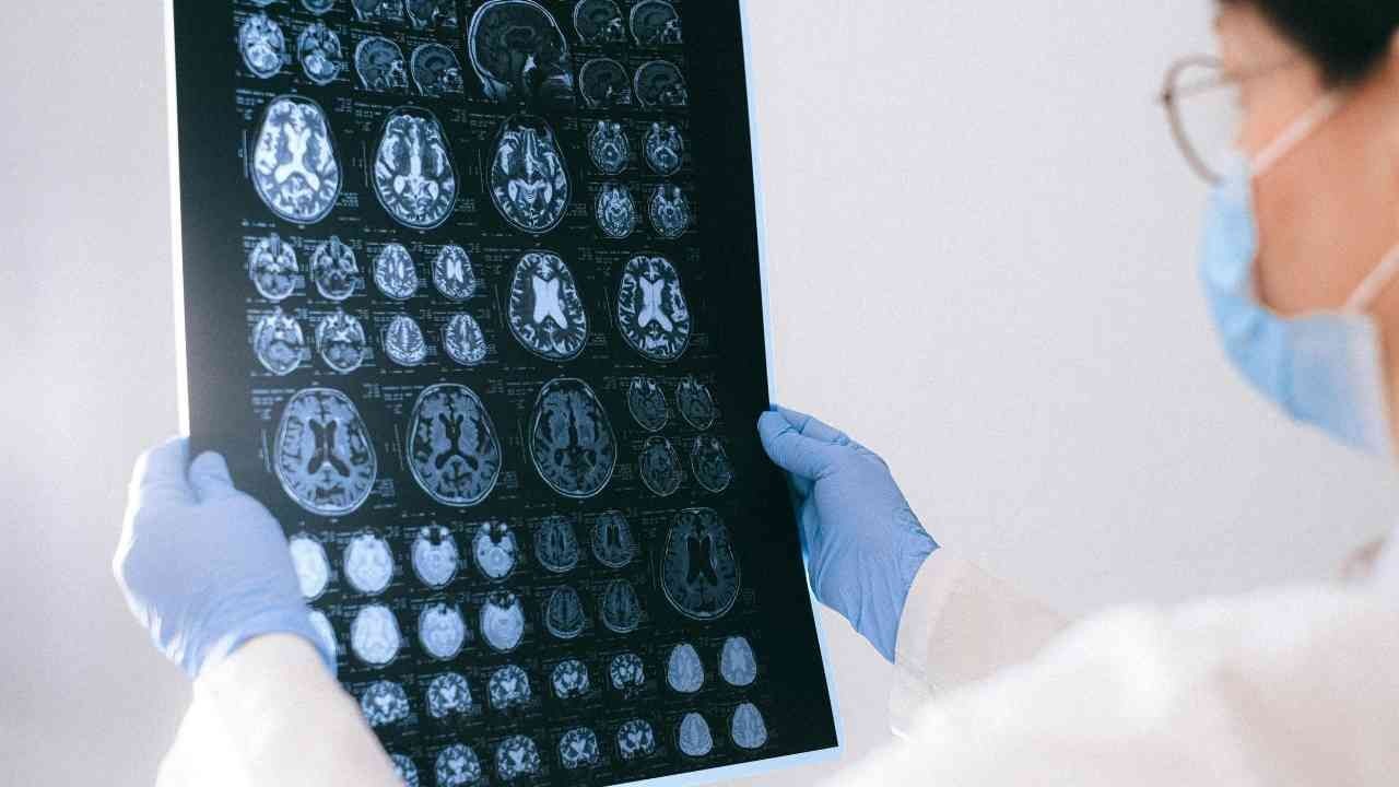 Hafife almayın: Alzheimer'de en sık görülen ilk belirti açıklandı - Resim: 1
